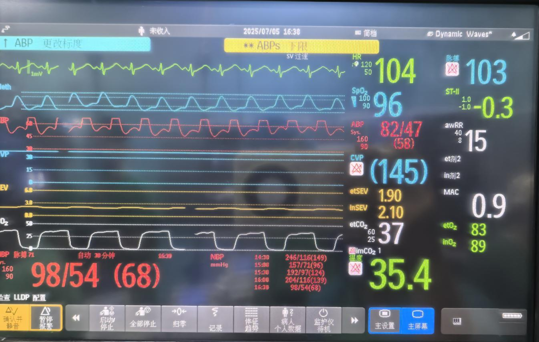大腿取钢丝怎么麻醉科室动态｜｜“钢丝上的舞蹈”——德宏州中医医院手术麻醉科成功护航嗜铬细胞瘤切除术_https://www.jmylbn.com_新闻资讯_第3张