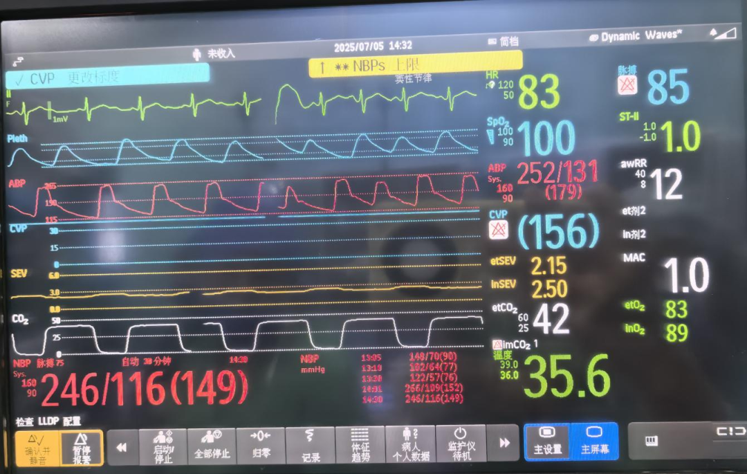 大腿取钢丝怎么麻醉科室动态｜｜“钢丝上的舞蹈”——德宏州中医医院手术麻醉科成功护航嗜铬细胞瘤切除术_https://www.jmylbn.com_新闻资讯_第2张