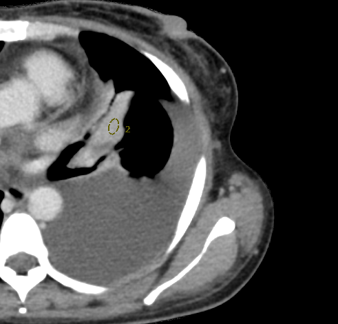 联影有哪些CT医疗服务 ｜ 我院放射科引入联影uCT 960+高端CT设备，开启精准影像诊疗新篇章_https://www.jmylbn.com_新闻资讯_第8张