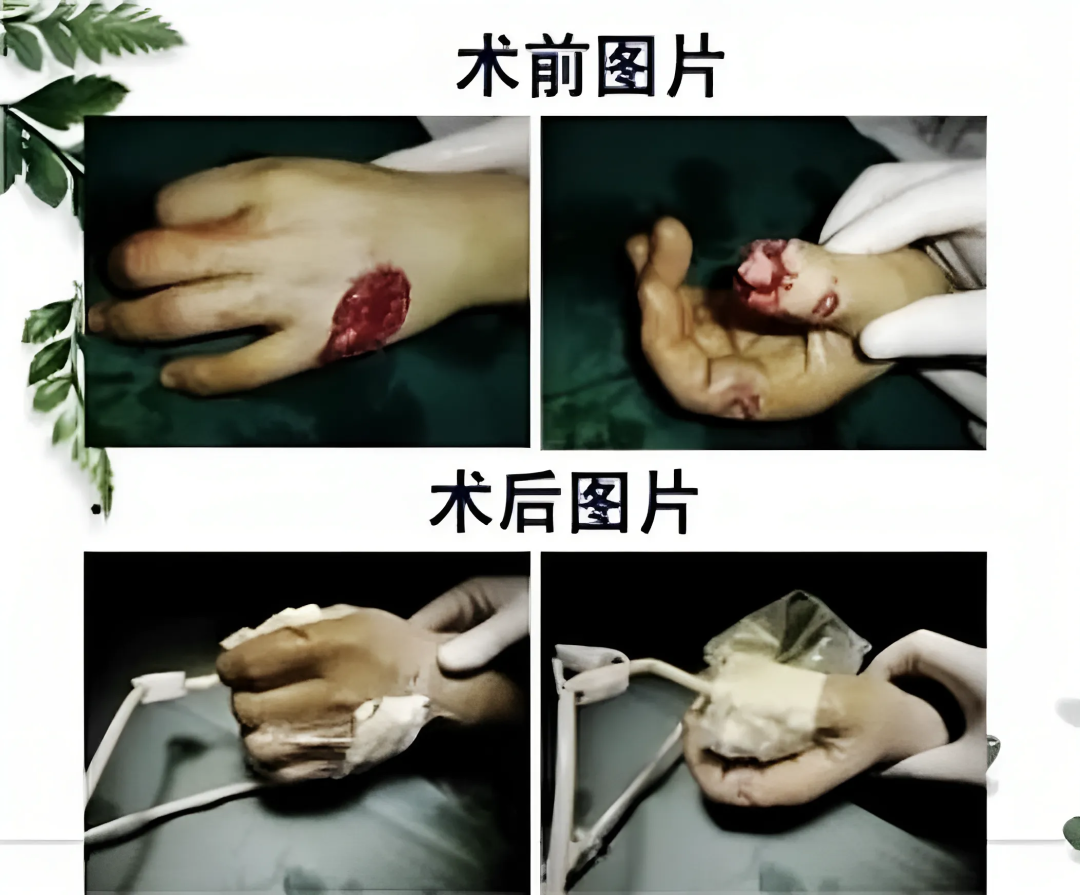 为什么负压引流健康小科普：负压封闭引流技术_https://www.jmylbn.com_新闻资讯_第2张