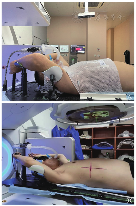 放疗体膜是什么不同体位固定方式对肺部肿瘤主动呼吸控制放疗精准度影响的研究_https://www.jmylbn.com_新闻资讯_第4张