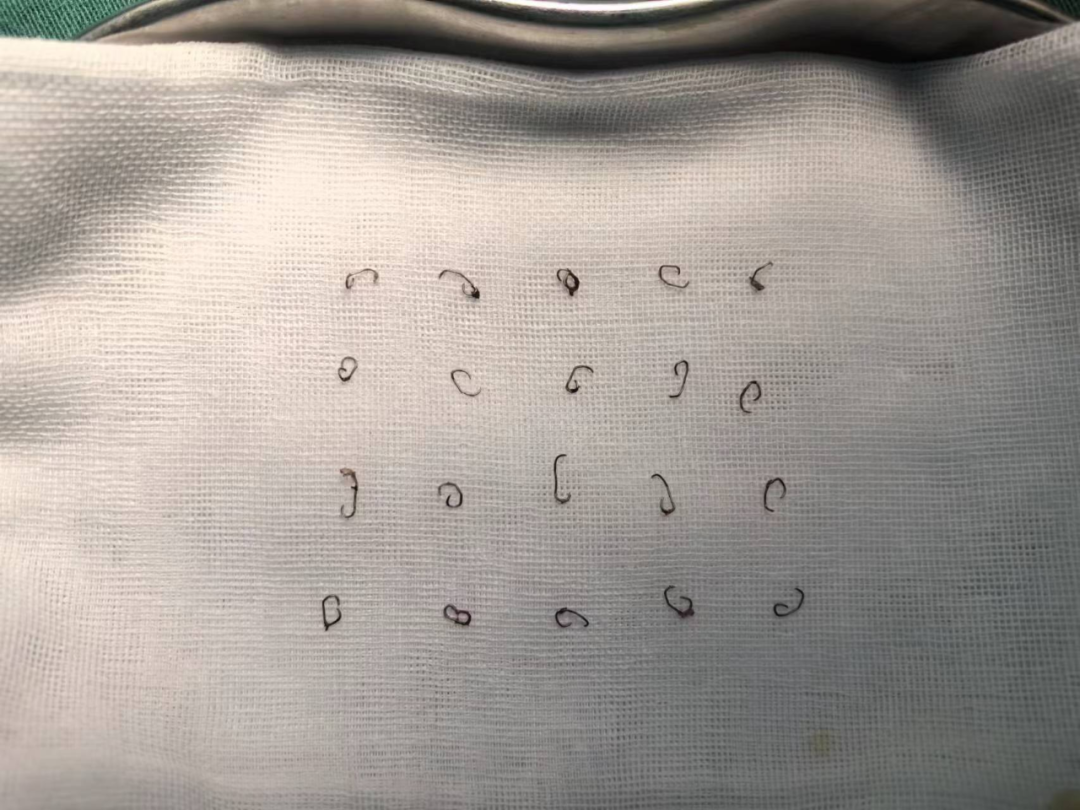 痔疮吻合钉长什么样八旬老人术后隐痛两年难解，元凶竟是体内“小金属刺”！_https://www.jmylbn.com_新闻资讯_第6张