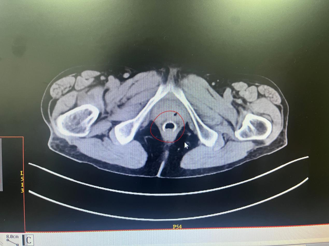 痔疮吻合钉长什么样八旬老人术后隐痛两年难解，元凶竟是体内“小金属刺”！_https://www.jmylbn.com_新闻资讯_第5张