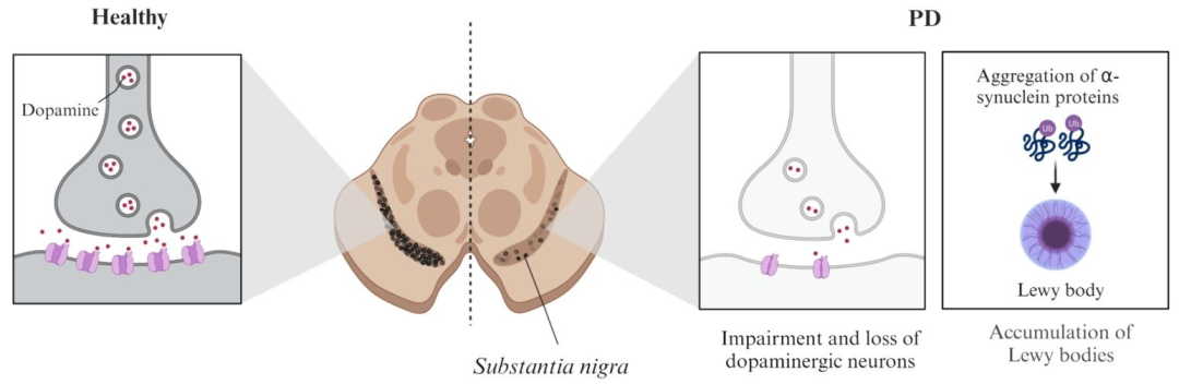突破帕金森病給藥瓶頸：納米技術+微針貼片，皮膚上的“智能藥庫