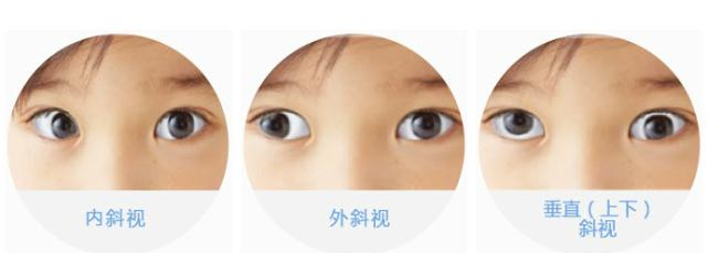 什么样的斜视需要做手术？手术标准和手术时机讲解来啦！-眼健康常识-公益科普-本部-山东第一医科大学附属青岛眼科医院|山东省眼科研究所【官方网站】