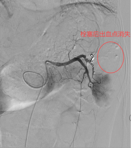 明胶在血管怎么降解脾脏破裂必须要切掉脾脏吗？医生：不一定！它可以保你脾脏一命_https://www.jmylbn.com_新闻资讯_第4张