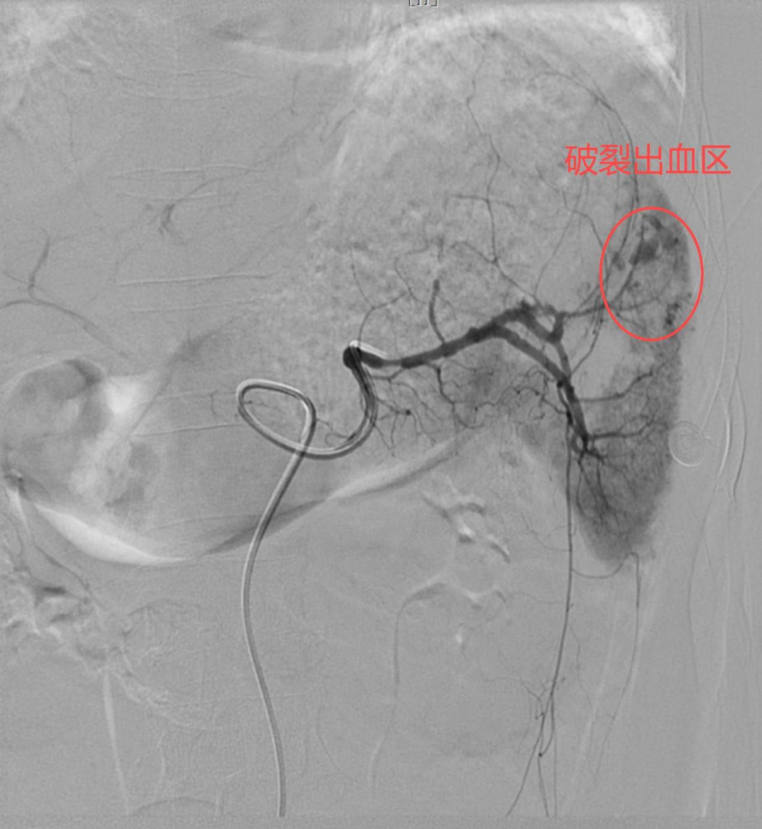 明胶在血管怎么降解脾脏破裂必须要切掉脾脏吗？医生：不一定！它可以保你脾脏一命_https://www.jmylbn.com_新闻资讯_第3张