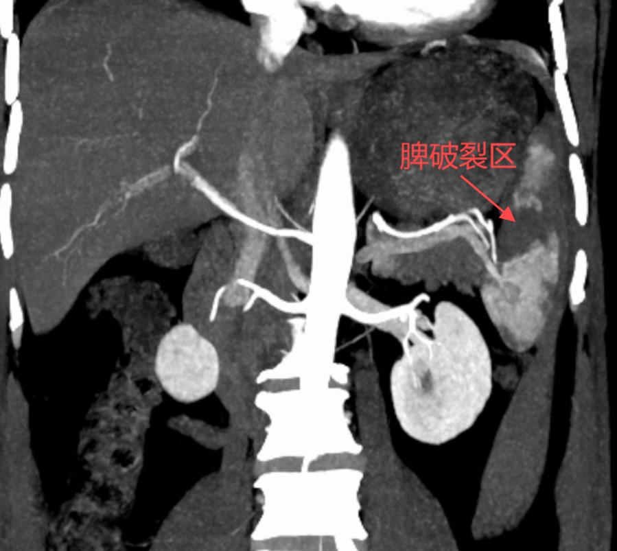 明胶在血管怎么降解脾脏破裂必须要切掉脾脏吗？医生：不一定！它可以保你脾脏一命_https://www.jmylbn.com_新闻资讯_第2张