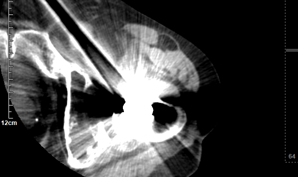 放射科怎么打印放射科新技术助力3D打印精准置换——记一例人工髋关节置换术后假体脱位患者的个性化治疗_https://www.jmylbn.com_新闻资讯_第4张