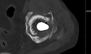 放射科怎么打印放射科新技术助力3D打印精准置换——记一例人工髋关节置换术后假体脱位患者的个性化治疗_https://www.jmylbn.com_新闻资讯_第3张