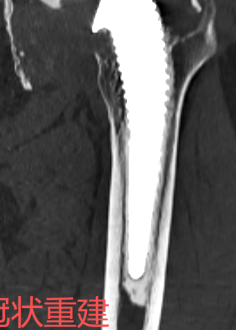 放射科怎么打印放射科新技术助力3D打印精准置换——记一例人工髋关节置换术后假体脱位患者的个性化治疗_https://www.jmylbn.com_新闻资讯_第5张