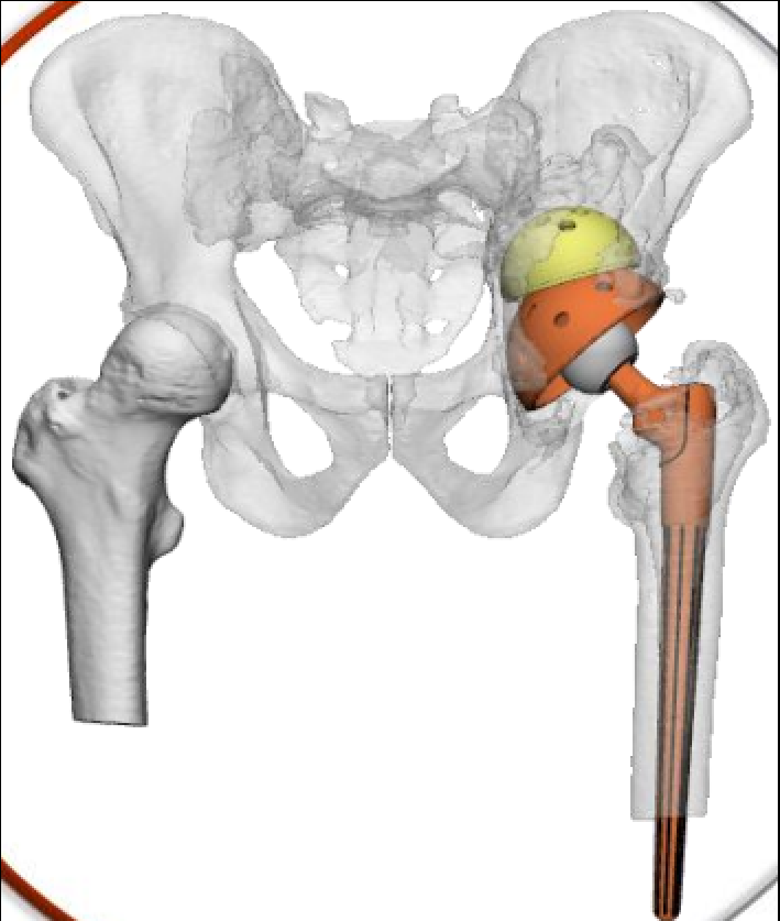 放射科怎么打印放射科新技术助力3D打印精准置换——记一例人工髋关节置换术后假体脱位患者的个性化治疗_https://www.jmylbn.com_新闻资讯_第7张