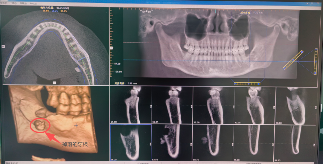 揪心！牙根“迷路”入喉咙，荆门市口腔医院颌面外科主任20分钟妙手取出