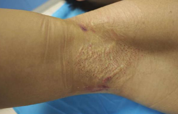 FUE怎么提取毛囊抬手就尴尬？告别“隐形体味”！FUE技术让腋臭治疗进入“无痕时代”​_https://www.jmylbn.com_新闻资讯_第8张