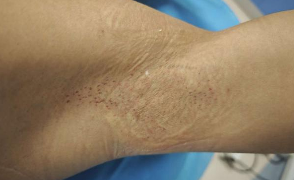 FUE怎么提取毛囊抬手就尴尬？告别“隐形体味”！FUE技术让腋臭治疗进入“无痕时代”​_https://www.jmylbn.com_新闻资讯_第7张