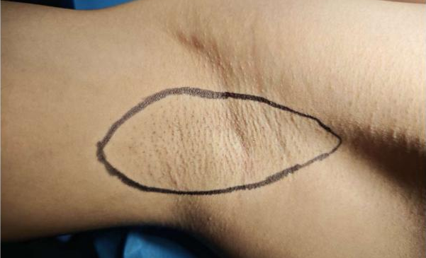 FUE怎么提取毛囊抬手就尴尬？告别“隐形体味”！FUE技术让腋臭治疗进入“无痕时代”​_https://www.jmylbn.com_新闻资讯_第6张