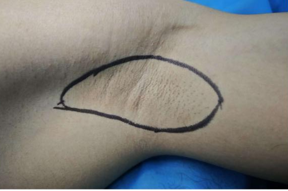 FUE怎么提取毛囊抬手就尴尬？告别“隐形体味”！FUE技术让腋臭治疗进入“无痕时代”​_https://www.jmylbn.com_新闻资讯_第5张