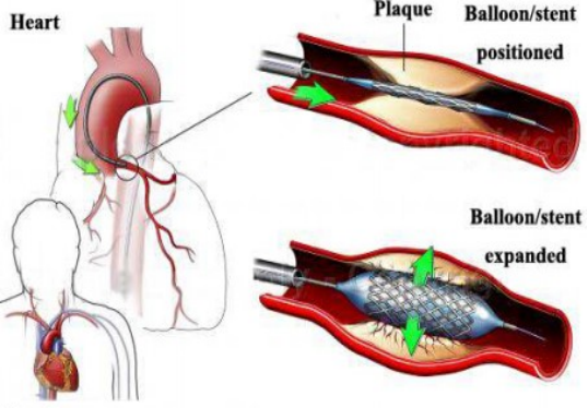 什么是外周支架血管支架：血管里的“生命隧道工”_https://www.jmylbn.com_新闻资讯_第6张