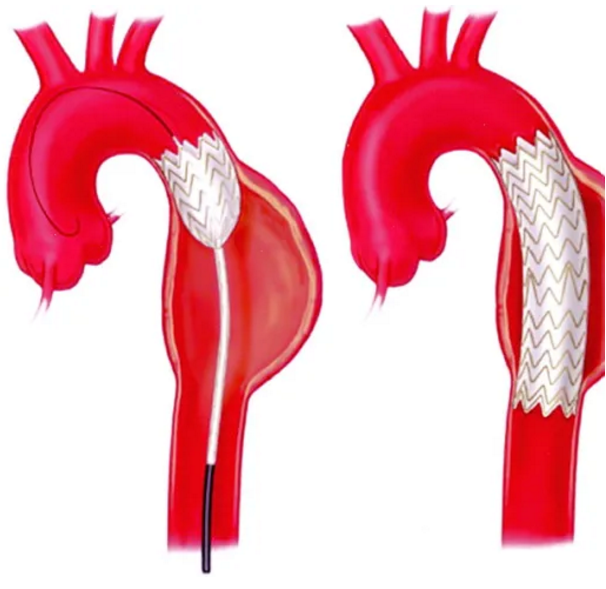 什么是外周支架血管支架：血管里的“生命隧道工”_https://www.jmylbn.com_新闻资讯_第10张