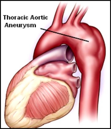什么是外周支架血管支架：血管里的“生命隧道工”_https://www.jmylbn.com_新闻资讯_第9张