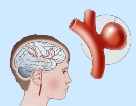 什么是外周支架血管支架：血管里的“生命隧道工”_https://www.jmylbn.com_新闻资讯_第8张