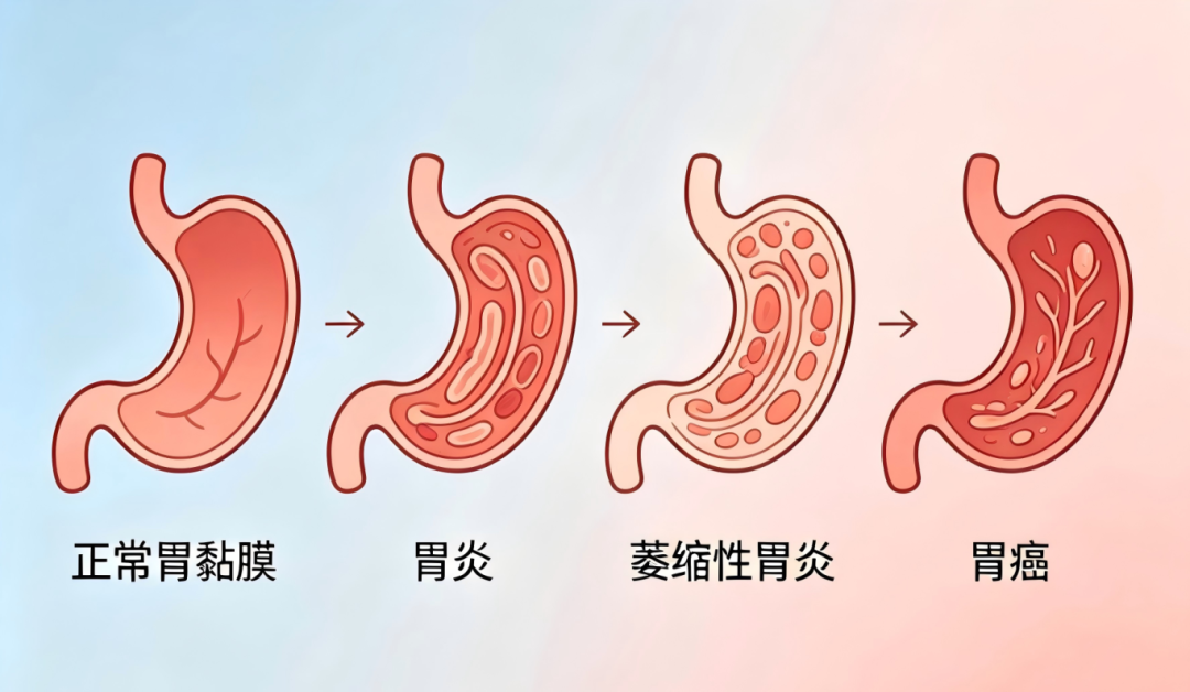胃癌科普与潘多姆检测介绍(1).png