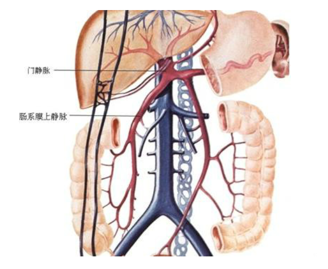 直面“栓”危！盐城市一院实施精准介入手术​破解急性肠系膜静脉血栓难题