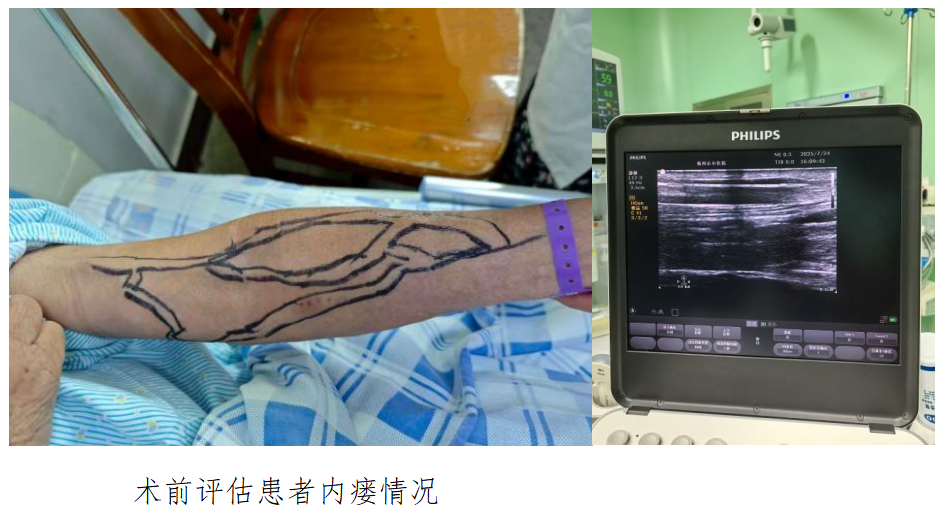 为什么血透还要打麻醉守护“生命通路”，舒适诊疗新选择——血透患者动静脉内瘘球囊扩张成形术联合臂丛麻醉_https://www.jmylbn.com_新闻资讯_第3张