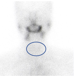 d-spect怎么检查【科普先锋】甲状腺也有“冷”和“热”？核医学的SPECT检查告诉你答案_https://www.jmylbn.com_新闻资讯_第5张