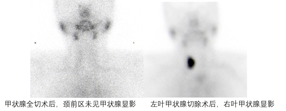 d-spect怎么检查【科普先锋】甲状腺也有“冷”和“热”？核医学的SPECT检查告诉你答案_https://www.jmylbn.com_新闻资讯_第7张