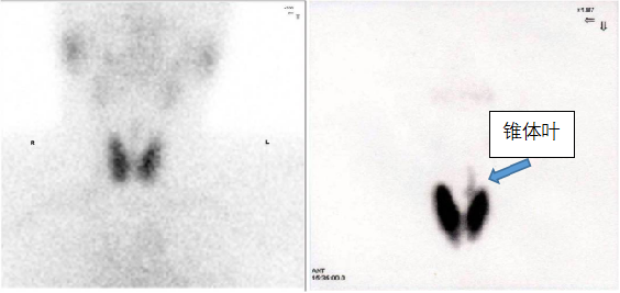 d-spect怎么检查【科普先锋】甲状腺也有“冷”和“热”？核医学的SPECT检查告诉你答案_https://www.jmylbn.com_新闻资讯_第3张