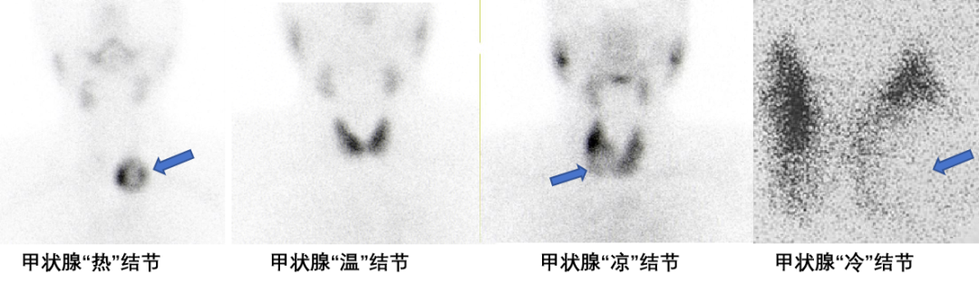 d-spect怎么检查【科普先锋】甲状腺也有“冷”和“热”？核医学的SPECT检查告诉你答案_https://www.jmylbn.com_新闻资讯_第6张